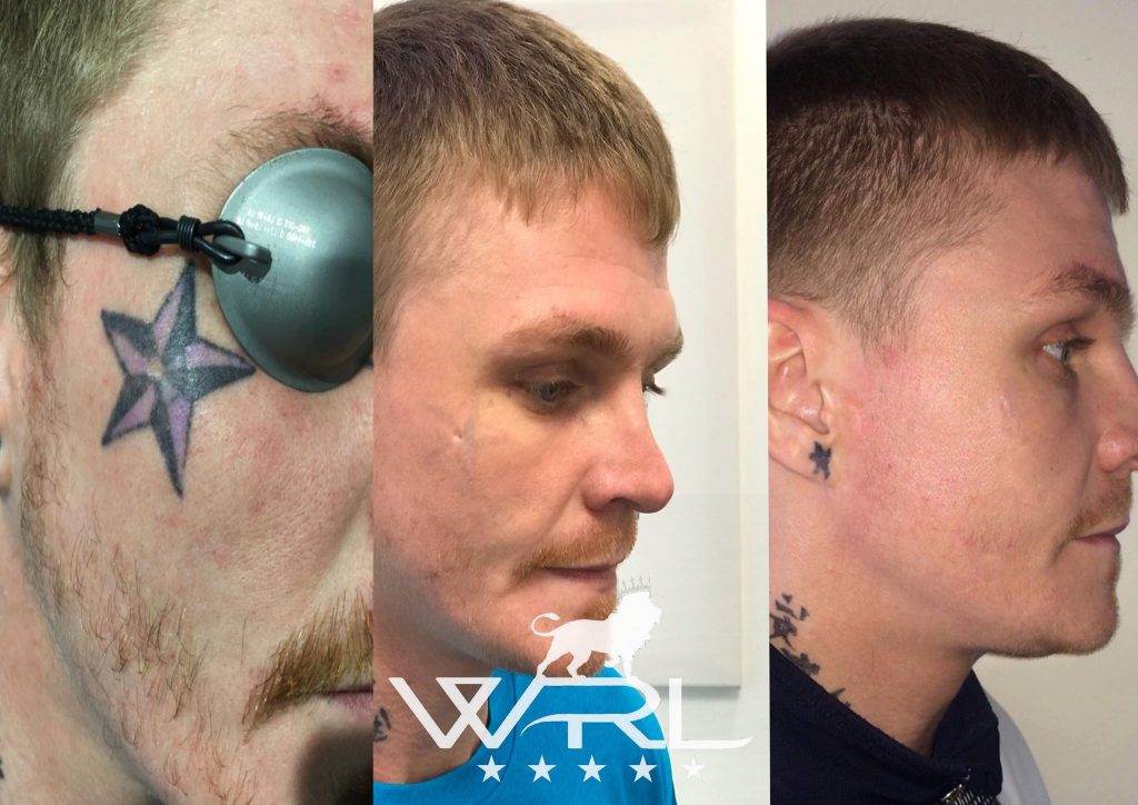 Facial Tattoo Remova